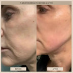 EvenSkyn® Lumo⁺: Premium Anti-Aging & Skin Tightening Handset (2026)