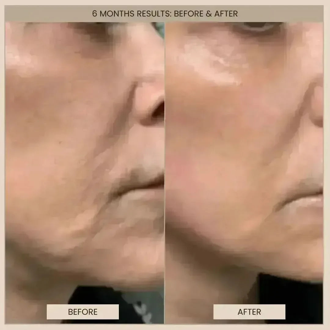 Lumo⁺ + Phoenix: Professional-Grade Skin Tightening and Lifting Duo
