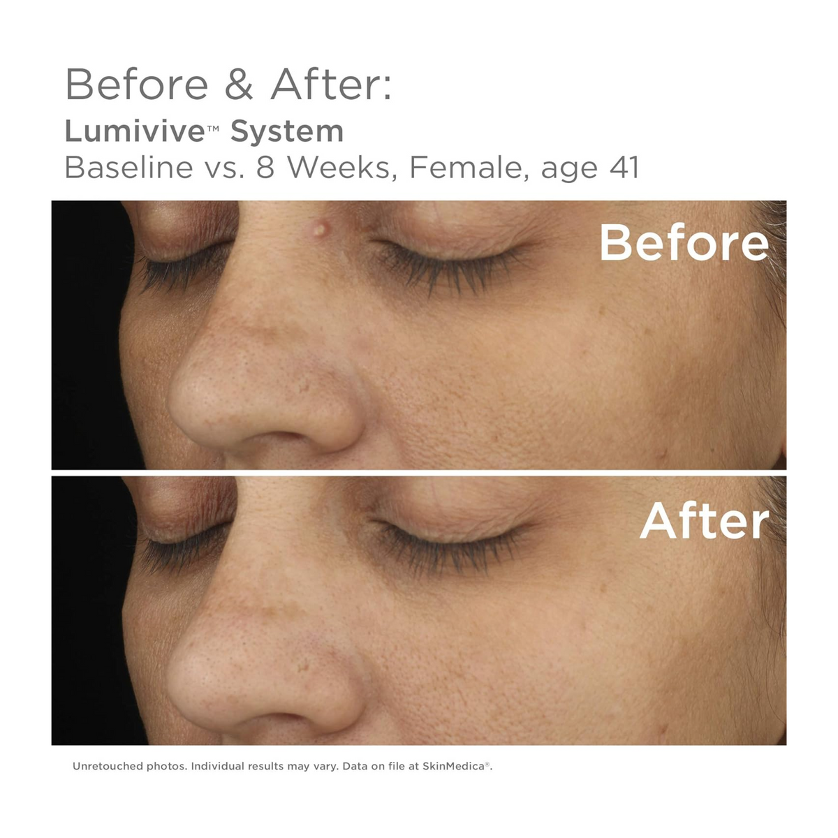 SkinMedica Lumivive™ System